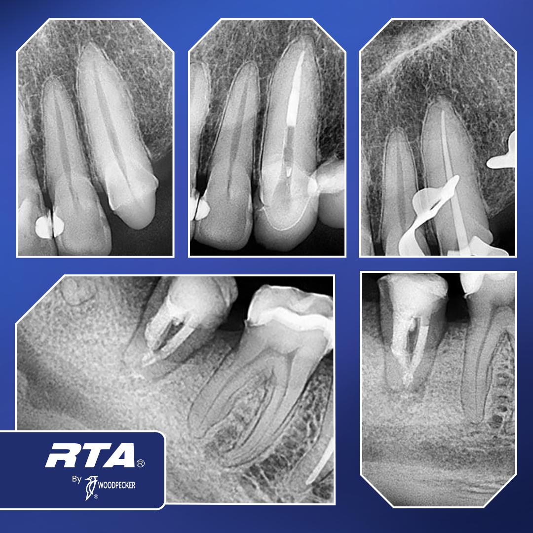 Sensor de Radiografia Dental I-Sensor H2 RTA By Woodpecker Con Laptop Lenovo licencia ilimitada